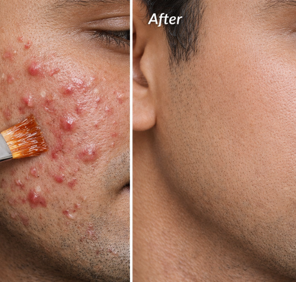 acne-peels